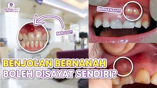 Download lagu CAN YOU CUT A PUS-FILLED LUMP ON YOUR GUM? DENTAL ABSCESS mp3 Download lagu CAN YOU CUT A PUS-FILLED LUMP ON YOUR GUM? DENTAL ABSCESS mp3