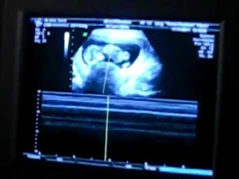 Come trattare una frattura dellarticolazione del ginocchio Mal di piedi a caviglie