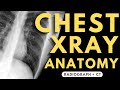 Chest X Ray Anatomy Radiology Anatomy Part 1 Prep How To Interpret A Chest X Ray