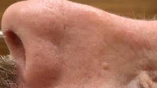 Tratamiento de Rinomodelación sin Cirugía