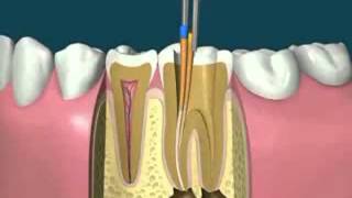 Philadelphia Root Canal Therapy