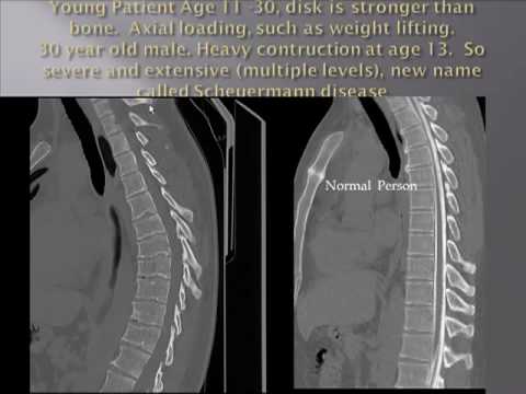 Schmorl's Node - Intravertebral Disk Herniation