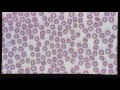 Blood Smear Evaluation
