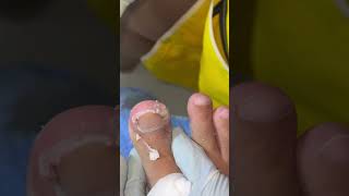 Ep_8186 Ingrown toenail removal 👣 กดแบบนี้โล่งไหม..โล่งมากครับ 😄 (clip from Thailand)