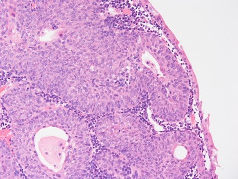 urothelialis papilloma kezelés helmint invázió, hogyan lehet azonosítani