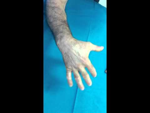 Come ripristinare il flusso sanguigno cerebrale in osteocondrosi Gomito quando flessione ed estensione dolente