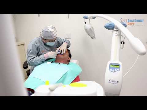 Teeth Whitening - Best Dental Care Los Algodones