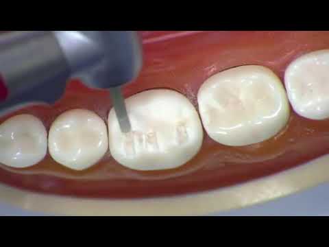 REST 528 - All metal Crown # 19 - Occlusal Depth Guides