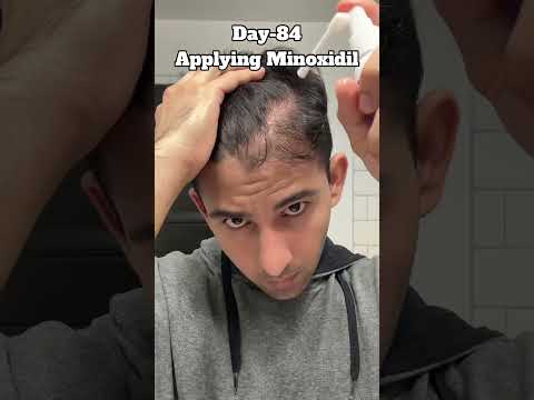 Day-85 Applying Minoxidil Till i Recover Hairline #hairloss #haircare #hairgrowth #minoxidil
