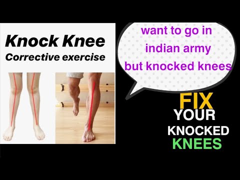 How to fix knocked knees | indian army knocked knees problem solved | knock knees kaise theek kare |