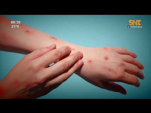 Confirman dos nuevos casos de sarampión en San Pedro