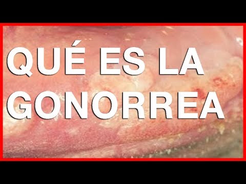 gonorrea sintomas y signos