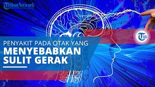 Ataxia, Penyakit atau Gangguan pada Otak yang Menyebabkan Penderitanya Kesulitan Bergerak