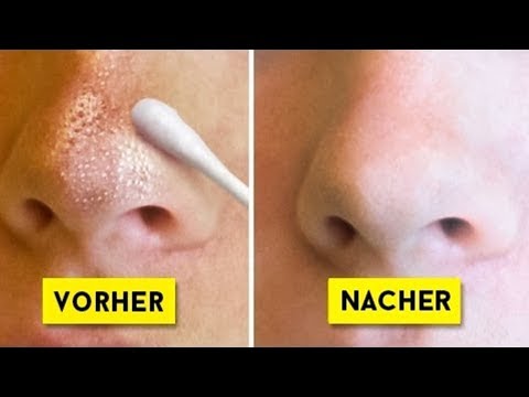 Eksoderil der Preis in den Apotheken kijewa Die Apothekenpräparate für die Behandlung der Nägel