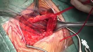 Trattamento ernia inguinale destra tipo M2 con uso di Ultrapro ™ Mesh