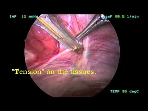 Endometriosis Excision by L.I.T.E. technique