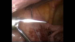TPEA Lifter - Ovarian Cyst and Myomectomy