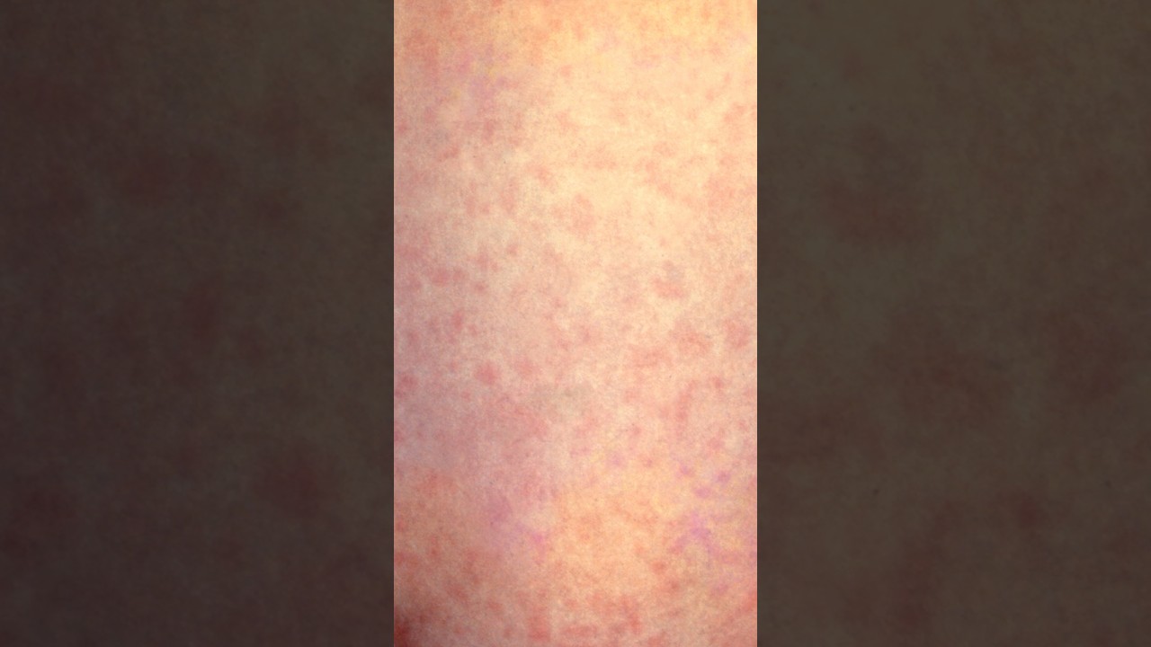 Measles symptoms and complications explained