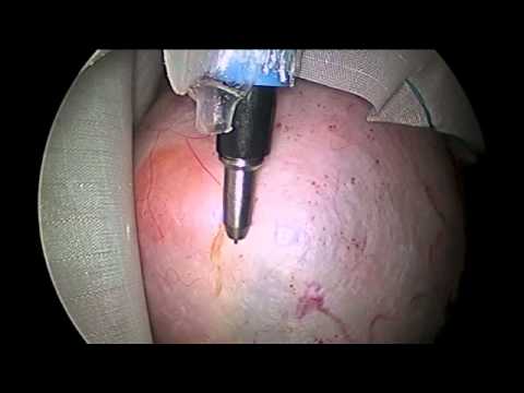 Ovarian cyst removal in a bag