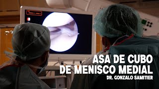 ROTURA EN ASA DE CUBO DE MENISCO MEDIAL
