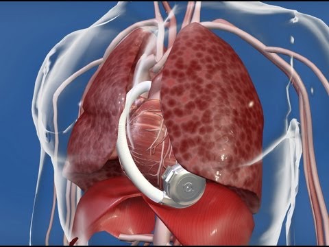 あなたの健康のために。スタンフォード大学のDipanjan Banerjee医学博士が左室補助装置（LVAD）について語る (Your Health: Stanford's Dipanjan Banerjee, MD, Discusses Left Ventricular Assist Device (LVAD))