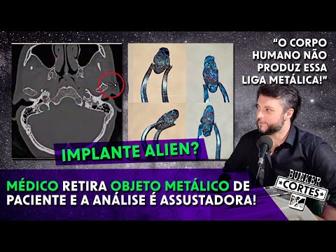 CHIP ALIEN? Mulher diz ter sido abduzida e retira objeto metálico do crânio | CORTES DO BUNKER X
