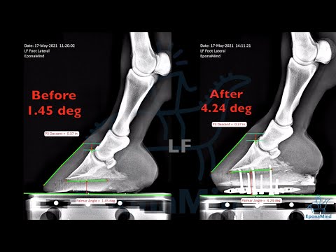 A Mild Case of High-Low Syndrome