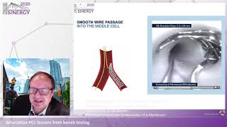 SINERGY 2020 - Bifurcation PCI: lessons from bench testing - DK-Crush stenting