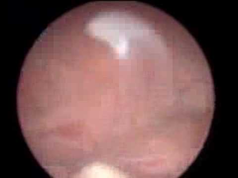 Laserowa waporyzacja prostaty techniką PVP 