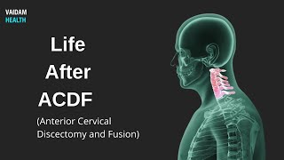 Жизнь после ACDF (передней шейной дискэктомии и слияния)