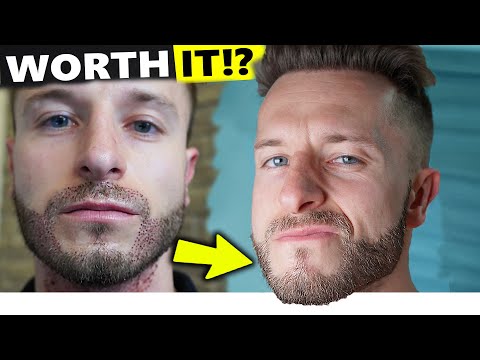 Regretting My Beard Transplant!? 1 Year before and after Result!