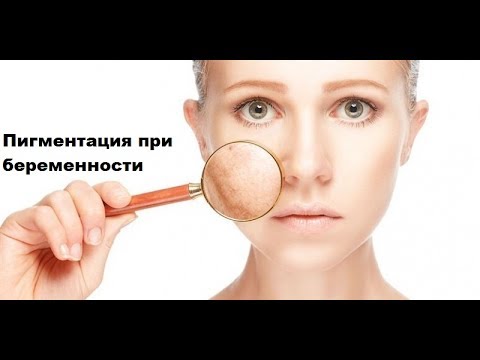 От пигментации на лице после родов Лимонная маска для лица от пигментных пятен