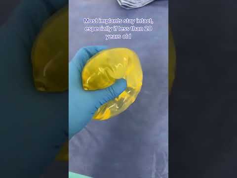 Warum sind diese 18 Jahre alten Brustimplantate leicht gelblich? #shorts #brustimplantate