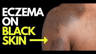 Doctor explains what ECZEMA looks like on BLACK SKIN - plus photos, diagnosis and treatment