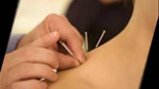 Acupuntura