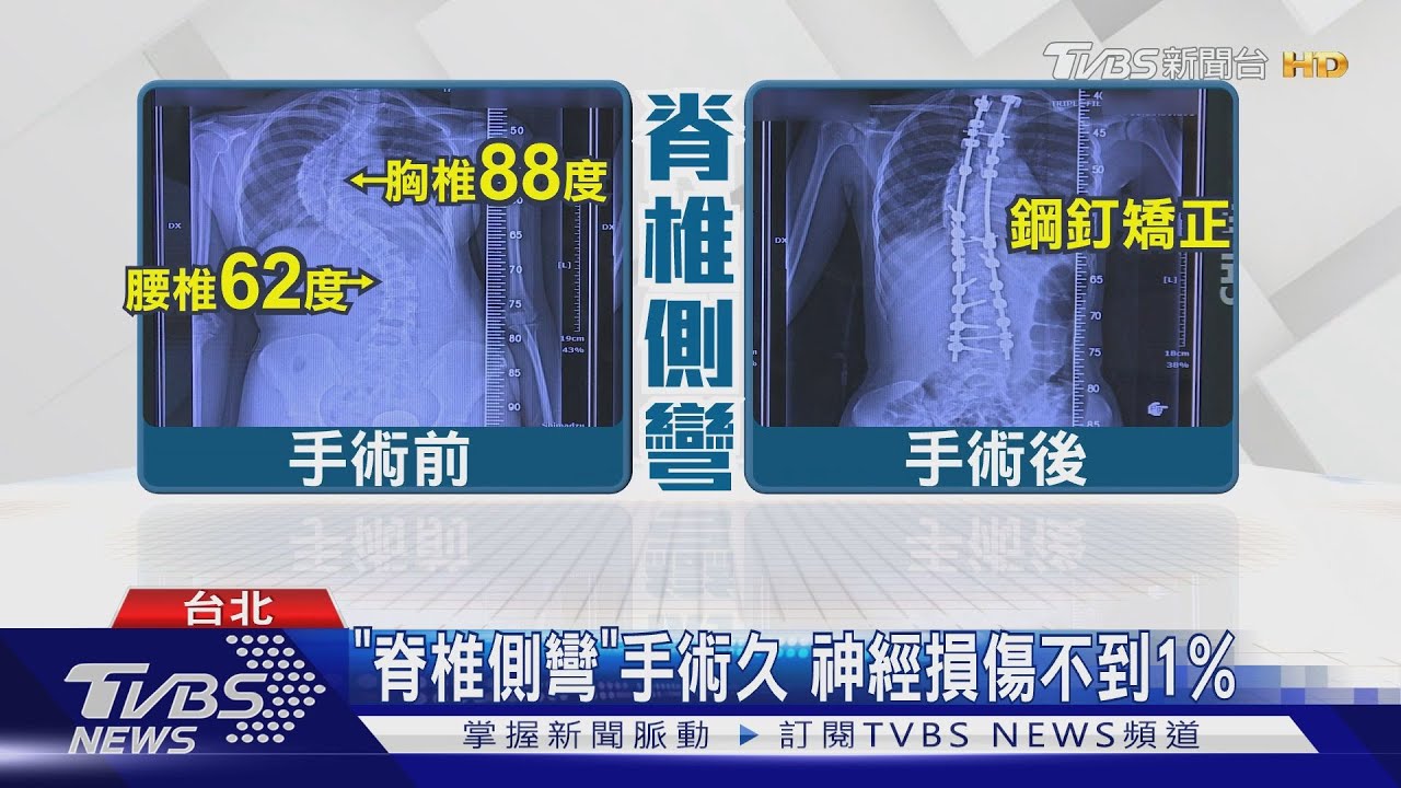 「脊椎側彎」角度超過10度!成因和姿勢不良無關 好發在這族群身上