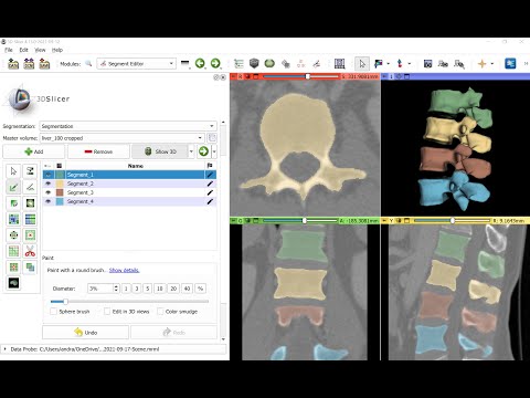 Semi-automatic vertebra segmentation on CT