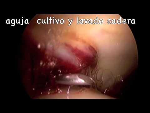 Quante volte si può ottenere un mal di testa con osteocondrosi cervicale Come aiutare in caso di osteocondrosi