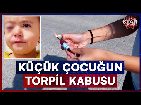 Exploding Torpedo Turns Little Boy's Life into a Nightmare | Star Main News