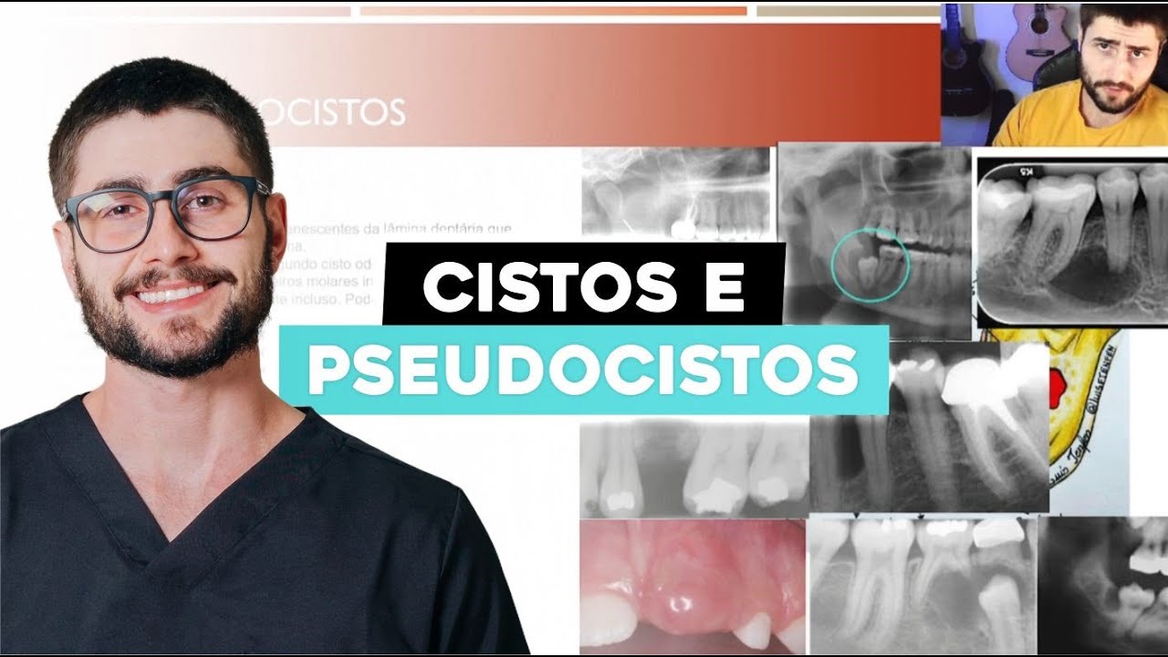 Cysts and pseudocysts of the maxillofacial region