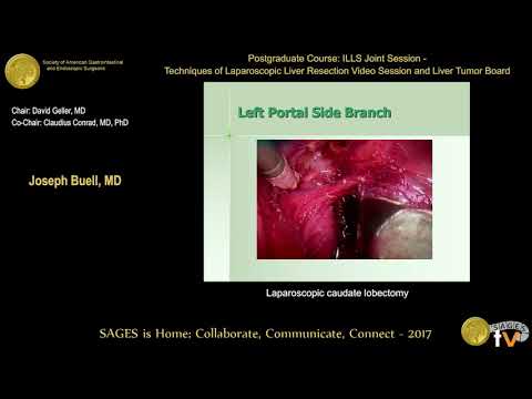 Laparoscopic Caudate Lobectomy