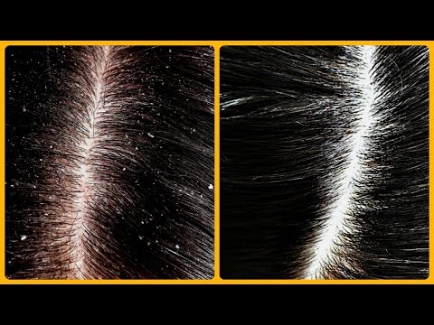 Magical cure for dandruff & hair fall /Home Remedies for Dandruff | Dandruff रूसी से छुटकारा Video
