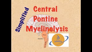 Central Pontine Myelinolysis, Osmotic Demyelination Syndrome, HYPONATREMIA in 6 min, COMLEX, USMLE