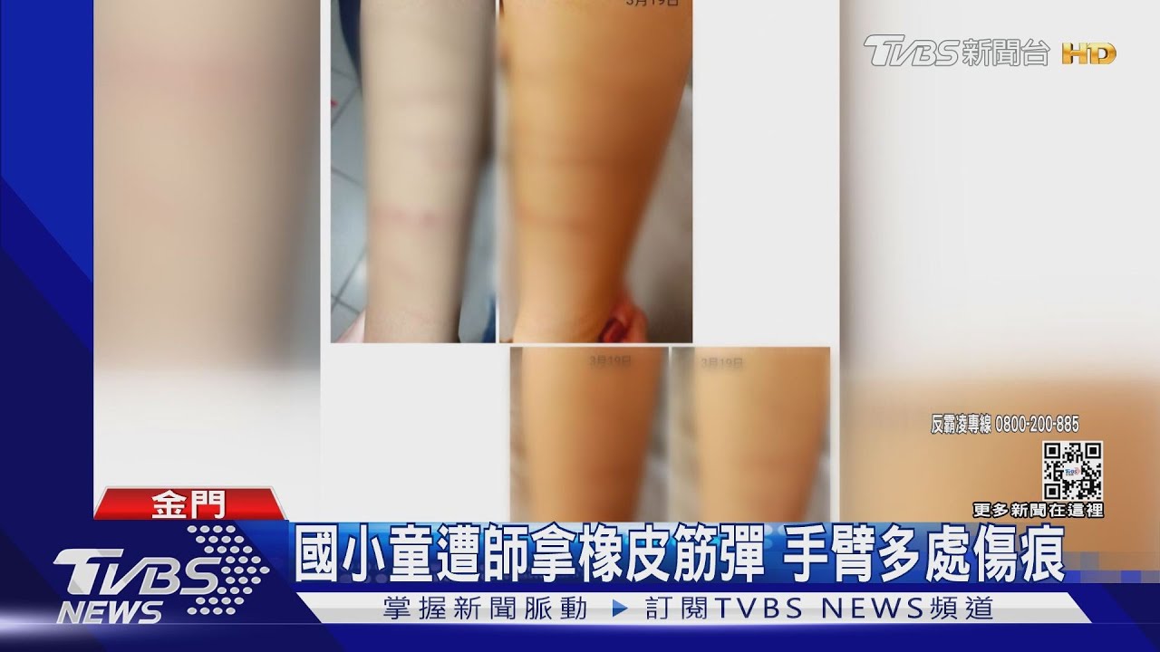 國小童遭師拿橡皮筋彈　手臂多處傷痕