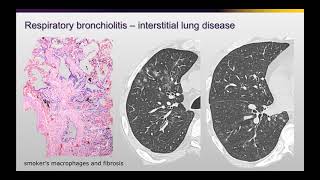 Imaging Cigarette Smoke Related Lung Injury