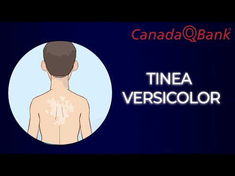 Tinea Versicolor