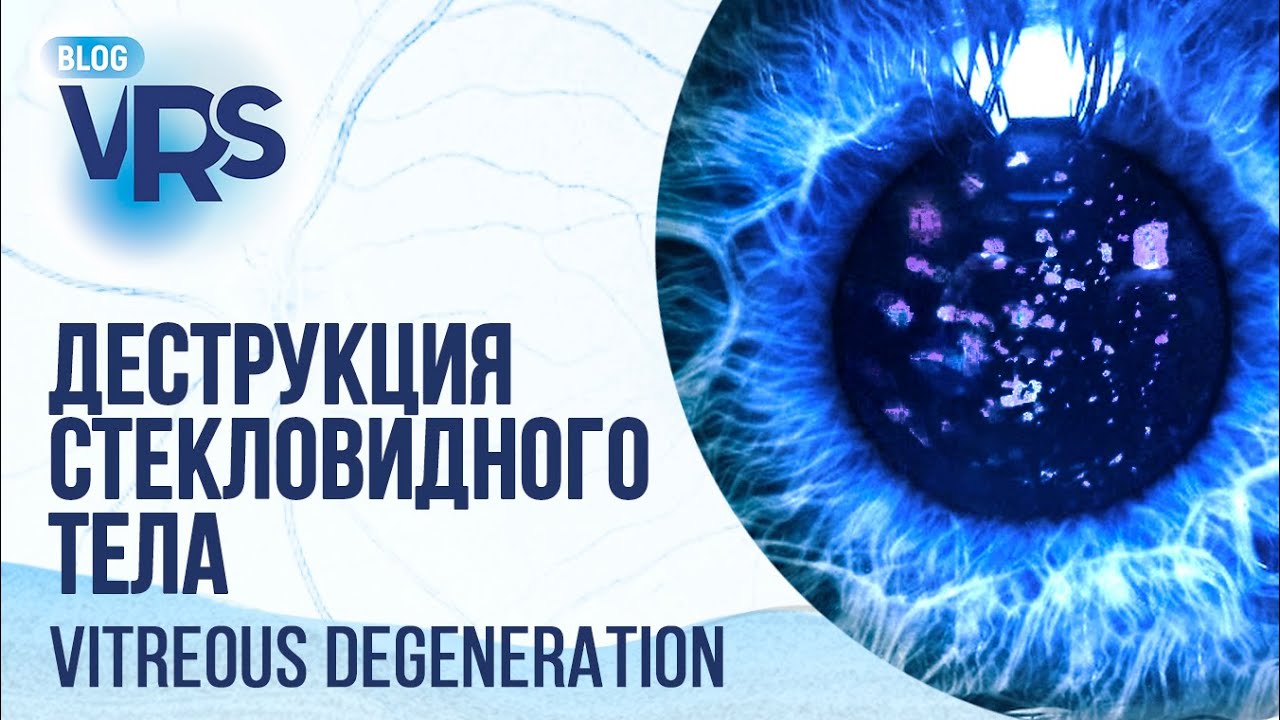 Деструкция стекловидного тела: нужно ли оперировать | Vitreous degeneration: to operate or not