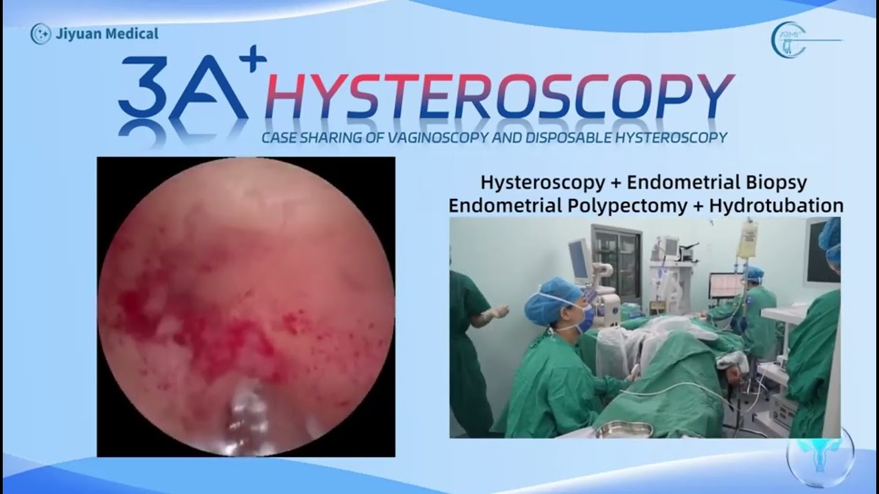 Endometrial Polypectomy+Hydrotubation