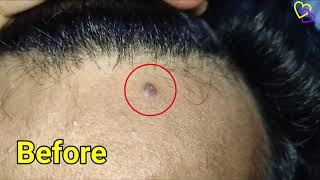 How To Remove Moles: Safe Home Remedies || Get Rid Of Face Skin Tags, Wart, With Apple Cider Vinegar