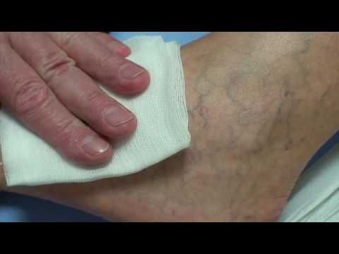 Hirudoterápia a lábak varikózisában